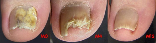 A fungal nail and its resolution with treatment over 12 months